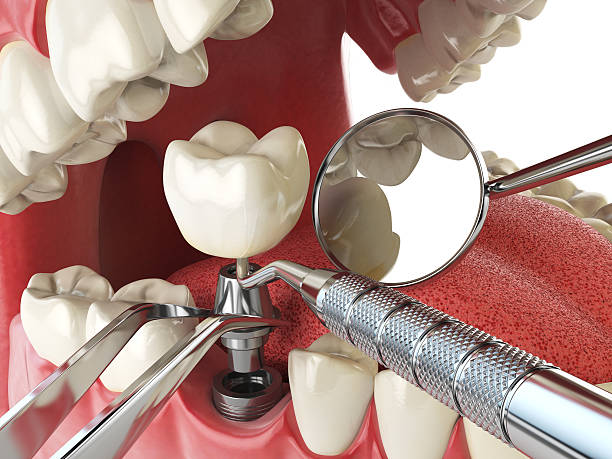 Best Emergency Dentist for Lost Fillings or Crowns in Finderne, NJ